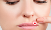 Herpes labial: 10 dicas da vovó para aliviar seus sintomas