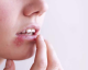 Herpes labial: alimentos que você deve comer e os que deve evitar.