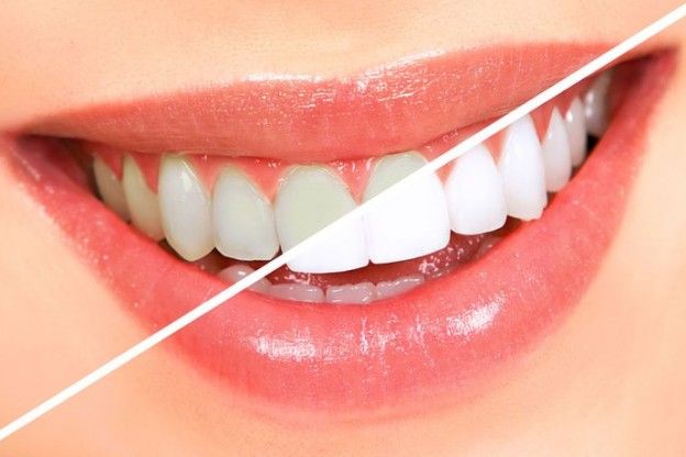 COME ELIMINARE TARTARO E GENGIVITE IN 4 STEP