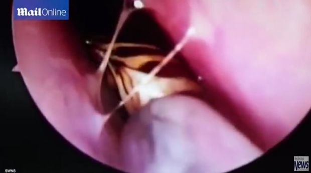 Médicos retiram barata ainda viva do crânio de uma mulher