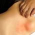 Errupções e irritação na pele