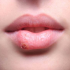 Herpes labial