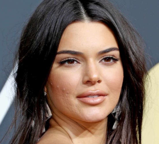 2.- a acne de kendall jenner