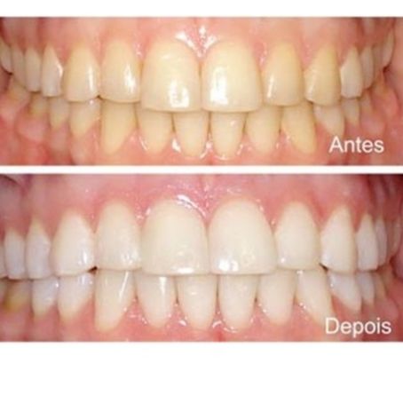 Como Clarear os dentes com Água Oxigenada