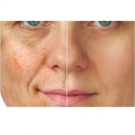 Remédio caseiro para rugas