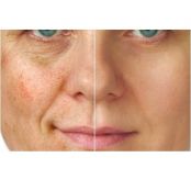 Remédio caseiro para rugas