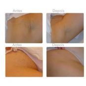 10 Dicas Caseiras para Clarear Axilas e Virilhas